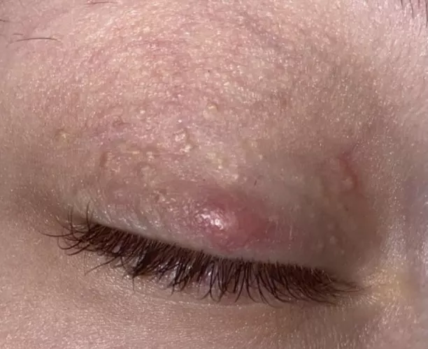 Milia Infected? I stupidly tried popping it. What to do? It's been 3 days of being swollen. I've tried teabags, warm compresses. I've had them for years. by ddodiee
