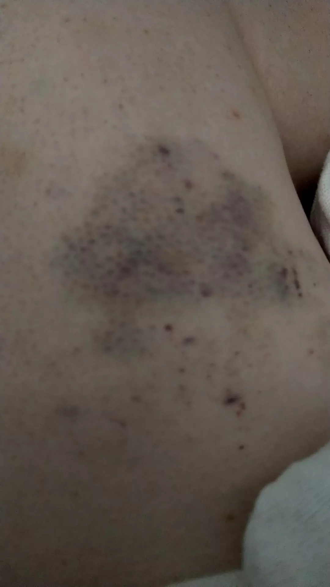 My beautiful bruise I gave myself on my left inner thigh, makes me wet to touch it posted by boytoysub1991