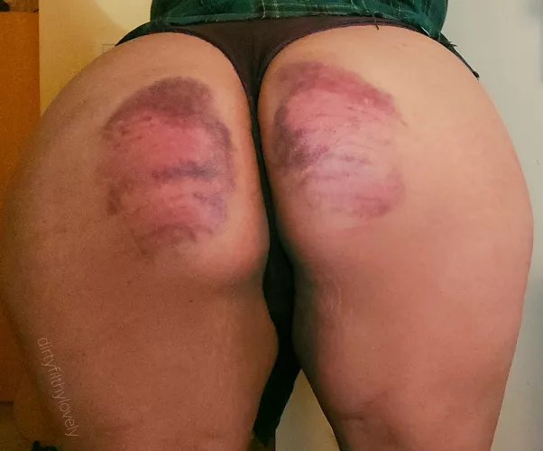 My best bruises to date. by DirtyFilthyLovely