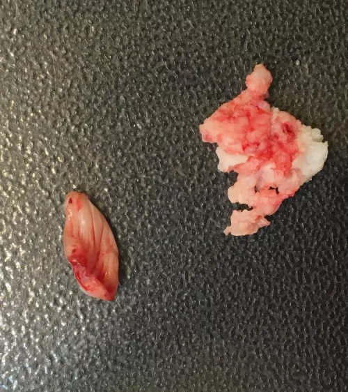 My cyst burst and I made my boyfriend pull the sac out of my shoulder while he was on LSD. He is NOT a popping fan! by jess0729ex
