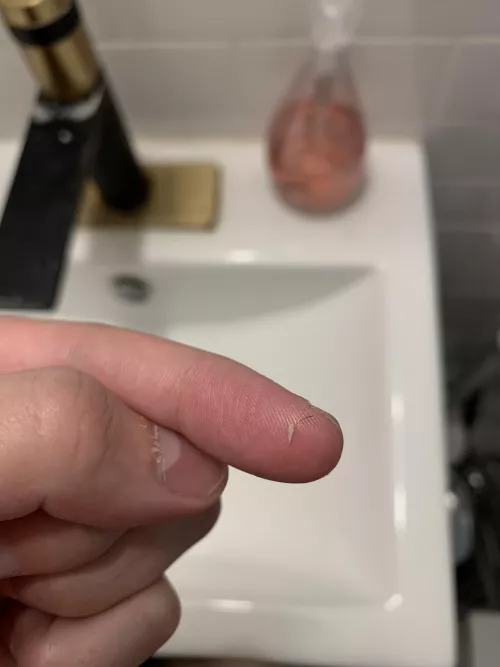 My default is cystic acne, so it’s nice to get some hairy pops once in a while! by dngayest