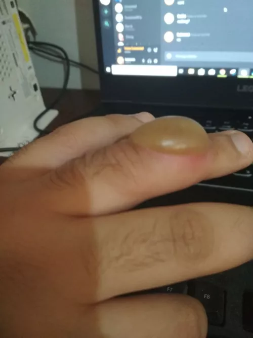 My finger after touching boiled oil then a glass of ice immediately after by Eight111
