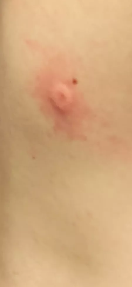 My friend shot my friend with a BB gun and grew an inverted nipple out of his back by Polkenator