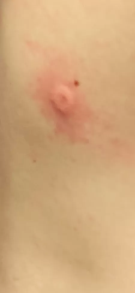My friend shot my friend with a BB gun and grew an inverted nipple out of his back by Polkenator