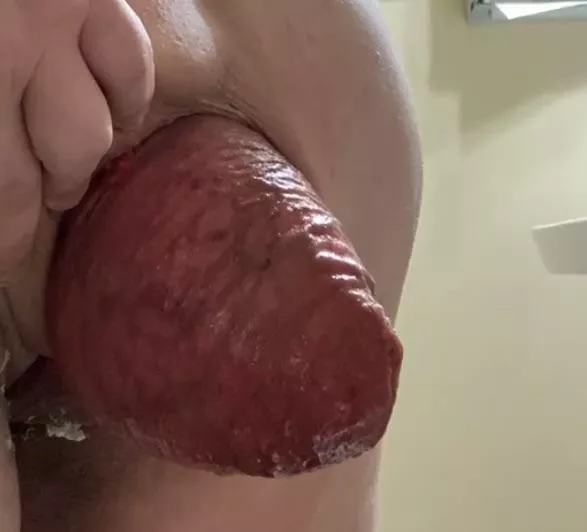 My giant prolapsed hole. posted by SolaG1998