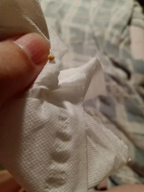 My husband got this milia/skin pearl off of me and told me to share it because it was so big 😭 by weinerdoggos