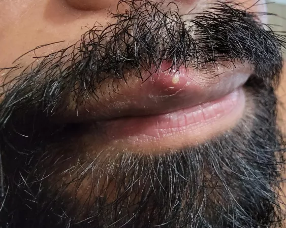 My husband has a juicy one on his lip but won't let me near it 🥺 by buildingbarriers