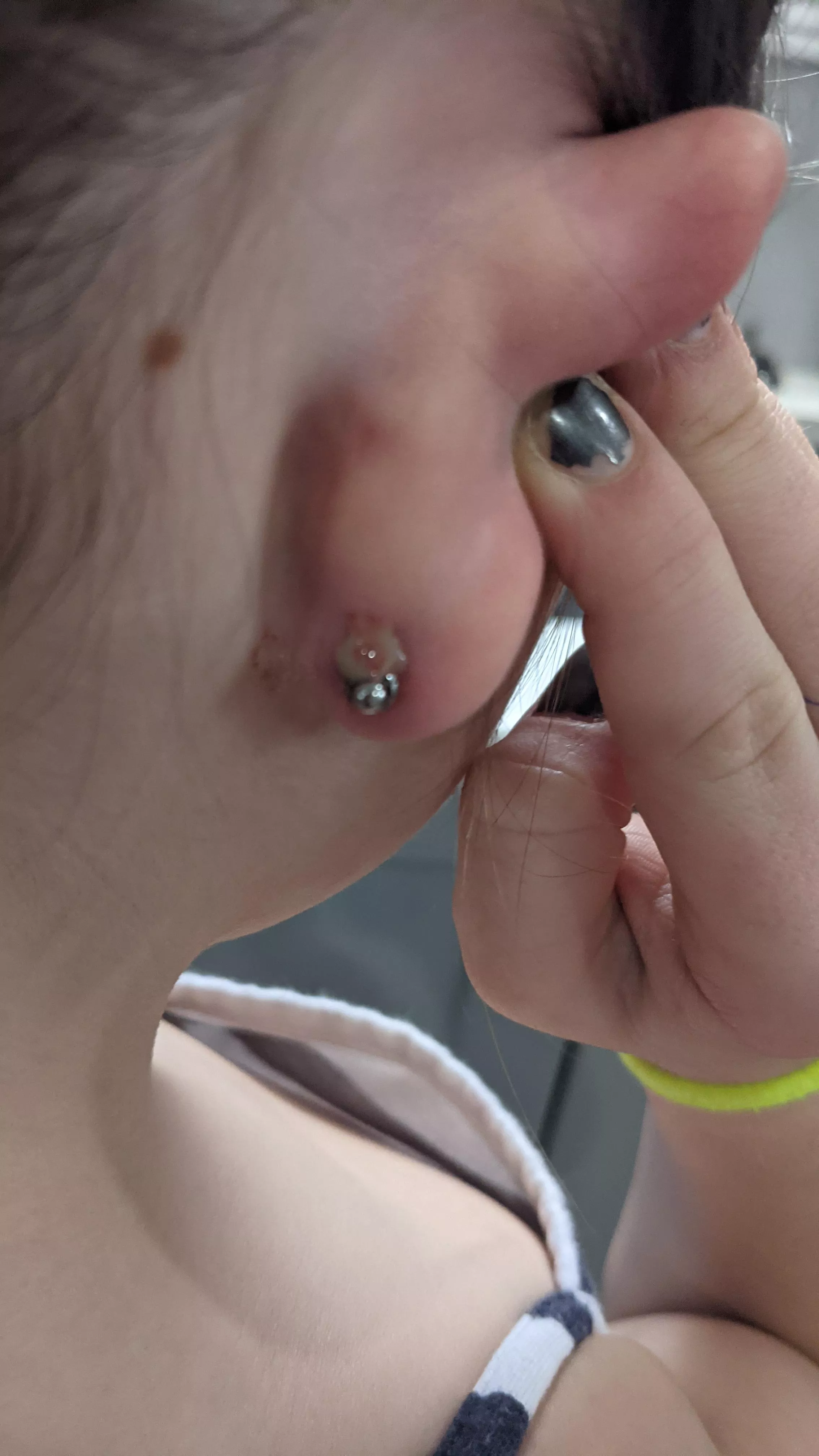 Nasty pop from my daughter's earring. Wish I had of got it on video, but she was having a fit! posted by Sharp-Pension-4236
