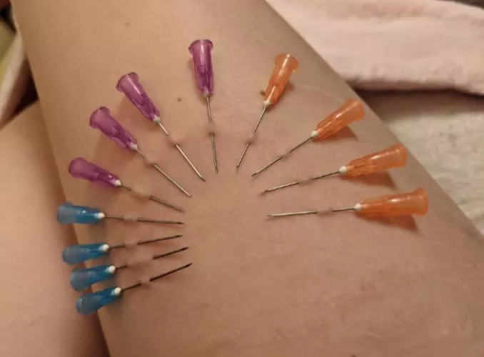 Needle decoration on my leg by GoodBadDad