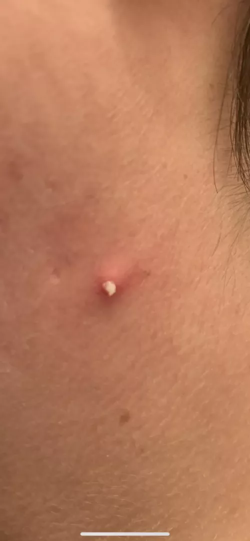 Nice pop on my neck this morning by iusestolivein