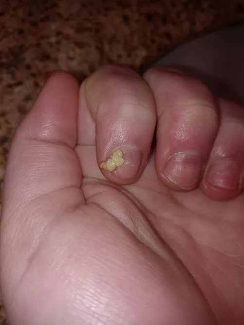 [oc] hadn't looked at my tonsils for a week or so and got these gems all at once (also just got acrylic nails off so don't mind my nails) by Slight-Comb-1708