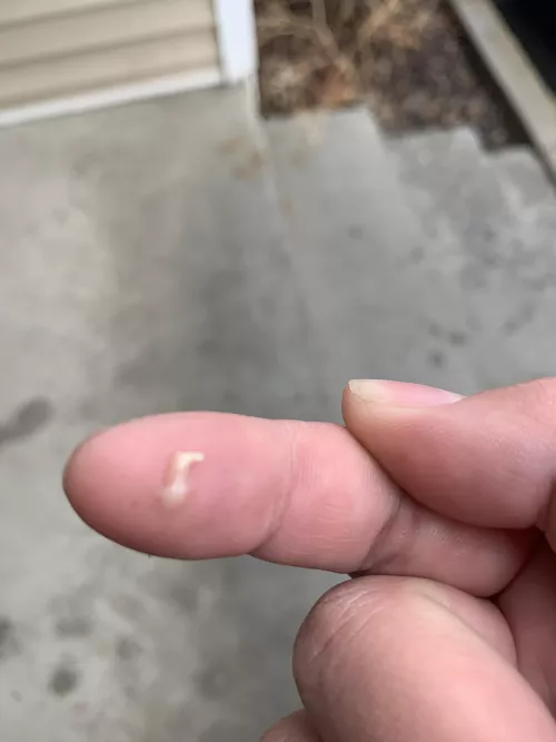 Oof, that feels better now. Aftermath of me squeezing a back cyst. by iusestolivein