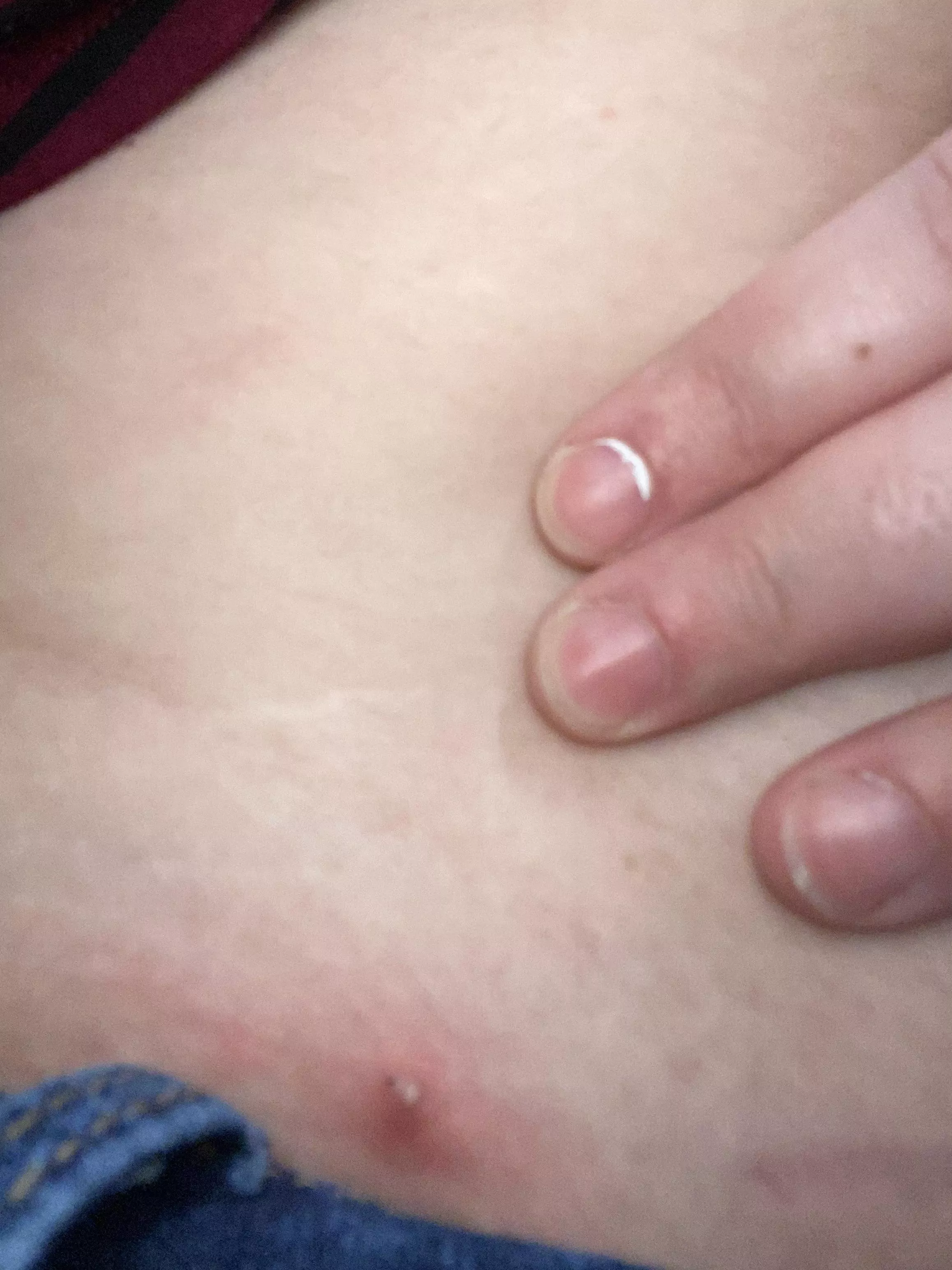 Pardon the wall paint in my nails. Woke up to this angry, painful one this morning. posted by BewitchedDeliverance