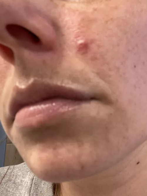 Period pimple. It keeps getting angrier. Some puss surfaced, not a lot. Hurts to even touch. by cmiles1019