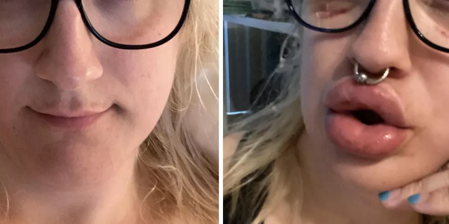 Permanent Lip Aug - Had extra collagen and fat from surgery put in my lips - I’ll have these pillows forever 👄 by ProtoBunny