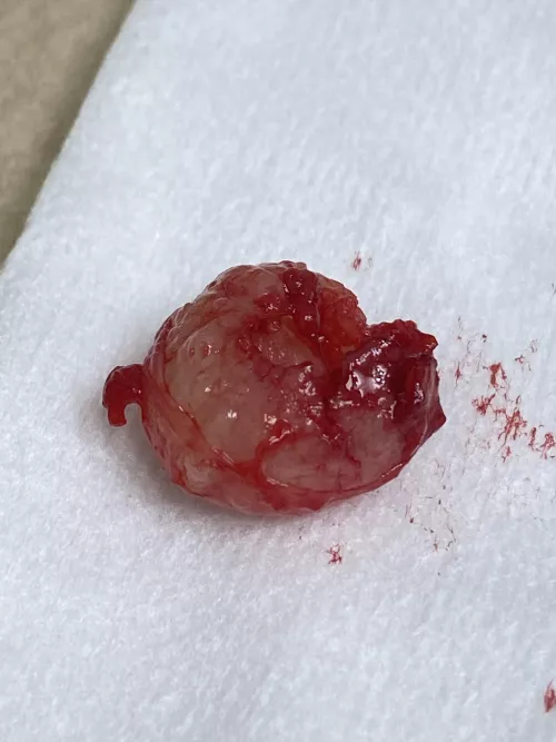 Pilar cyst removed from husband’s scalp today by xenophonica