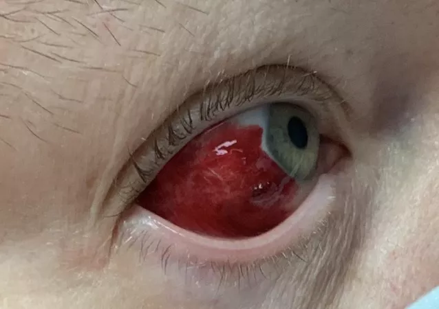 Popped blood vessel in my eye. It doesn’t hurt. by hurling-day