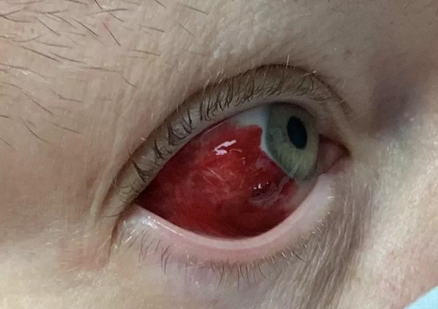 Popped blood vessel in my eye. It doesn’t hurt. posted by hurling-day