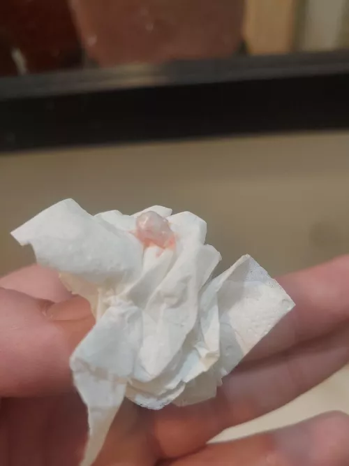 Popped this cyst out just now by jrbarber85