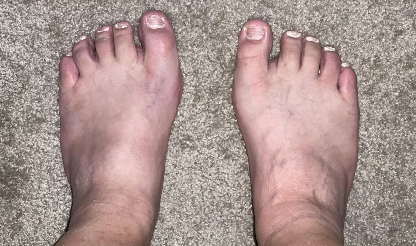 POV standing of my 13 6E wide feet. (Nails need to grow.) by stritlem