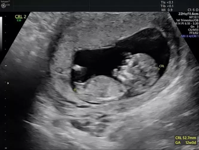 #Pregnancy scan.. Truly excited to share my wife's pregnancy scan report. Her bull bred her and she is successfully carrying it. Dream come true moments for me.. by Due-Welder-8347