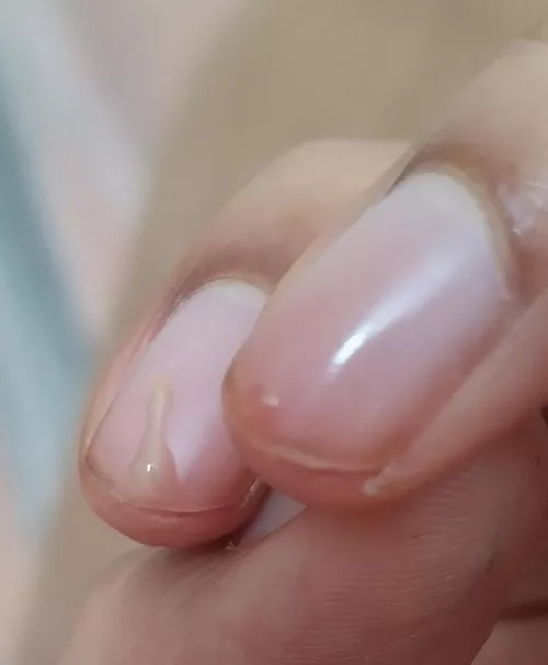 Pus from a pimple on my ear cartilage by anon240501