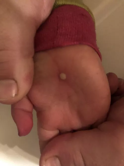 Random forbidden pop on 2 y/o daughter’s hand. No idea where it came from and it just keeps getting bigger. by punktomsheck