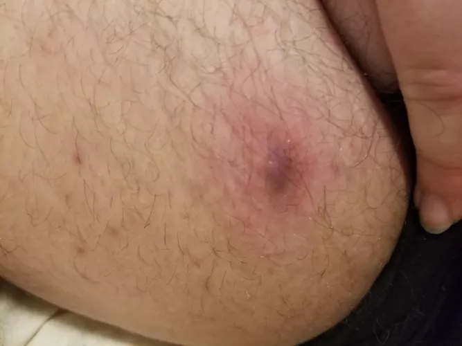 Really want to pop it but probs shouldn't. Doesn't hurt much at least by recovering_depresso
