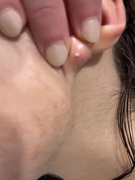 Result of wearing earrings after not wearing for 2 years by dumbledoresarmy7