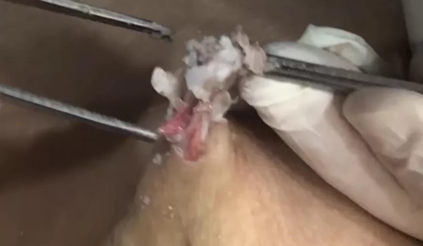Savage attempted removal of epidermal cysts WARNING It’s unbelievably frustrating & had very scary use of rat tooth tweezers! Link in comments. by Hunni_Bee