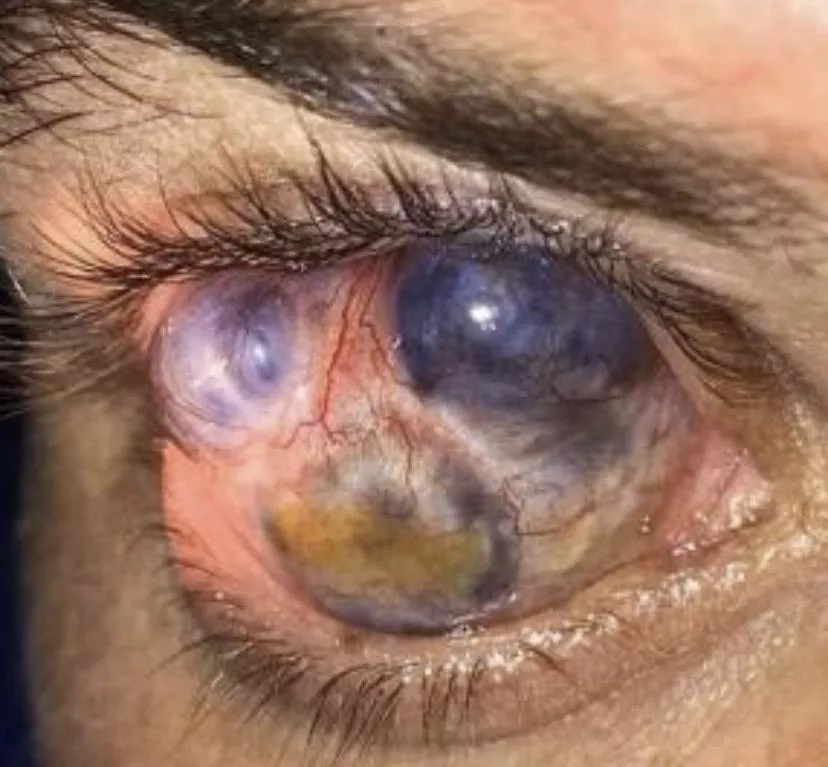 Scleromalacia Perforans, a type of inflammation of the eye. posted by KISSfanFOXV2