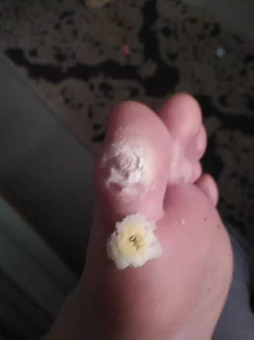 Second time trying to remove a corn on my big toe. Used salicylic acid patches for a week. by Dangerous-Bat-8698