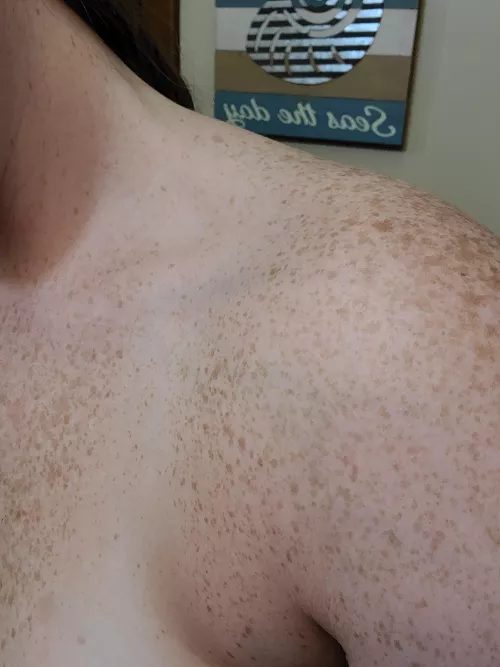 shoulder freckies by freckledxxfreak