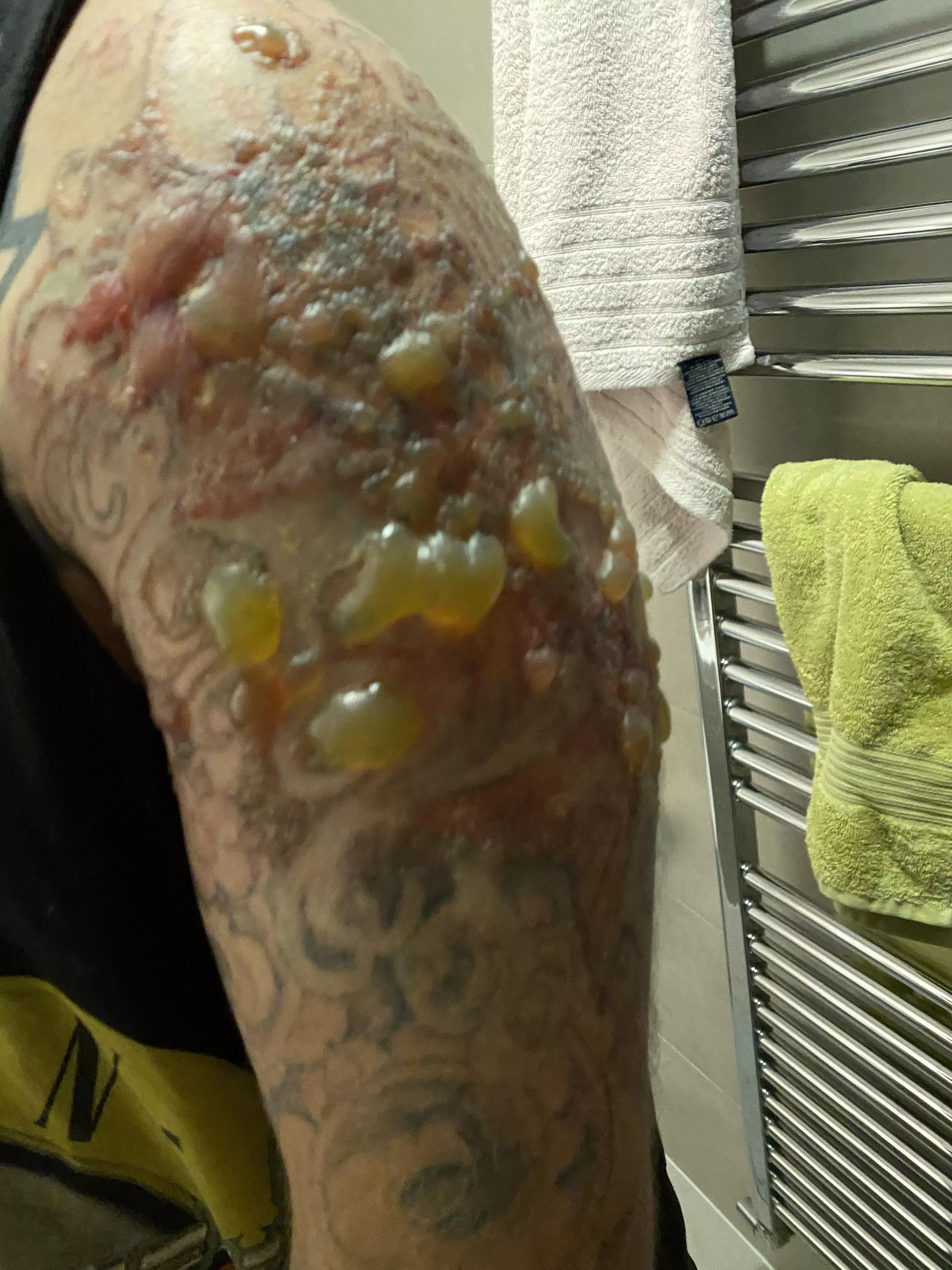 Some more laser blisters posted by Capt-bakedbeans