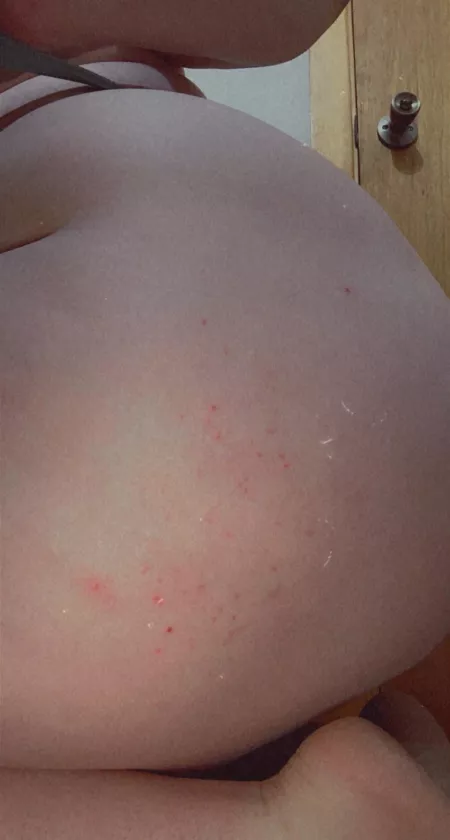 Sorry bout the eczema but that’s life, my ass is phat by Khulen21