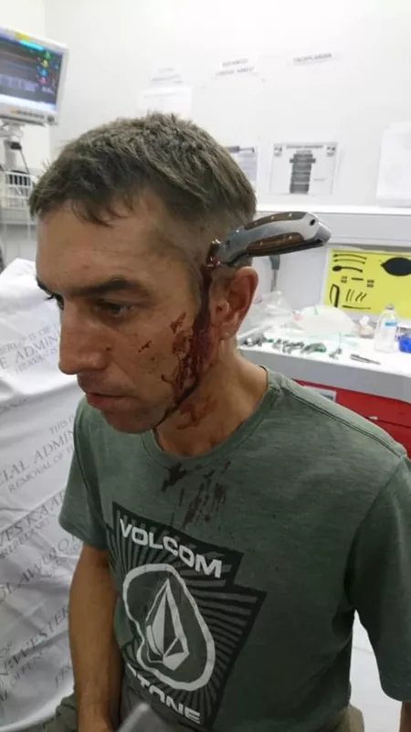 South African cyclist stabbed in head by WTFLemmeLogInPlz