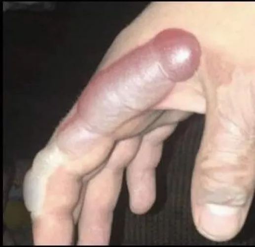 Spilled some hot liquid on my hand by Fresh-Stage7646