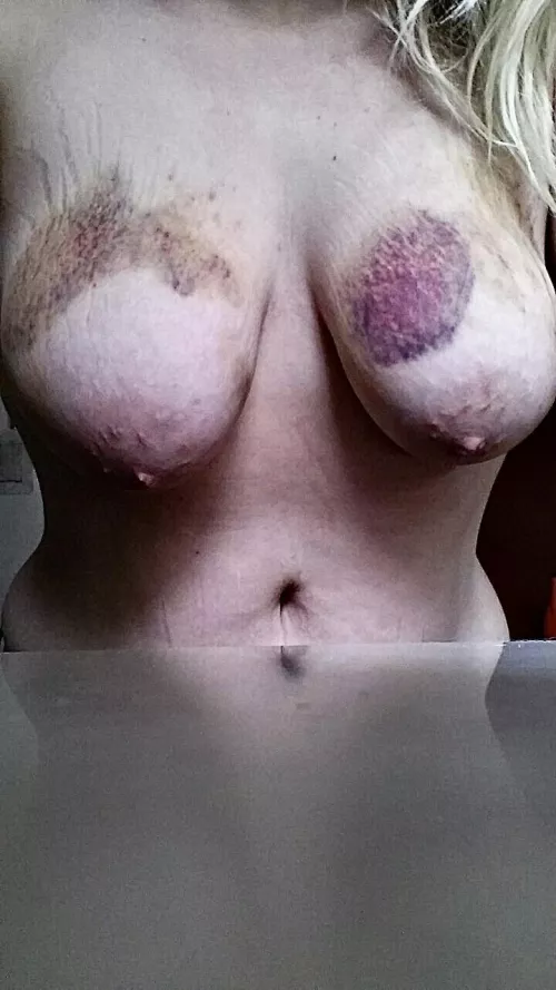 Stretchs marks fetish by PresentationNew6649