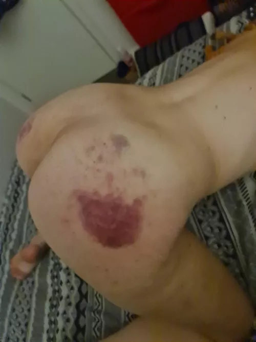 Submissive [F]reshly bruised. by SweetSourDom