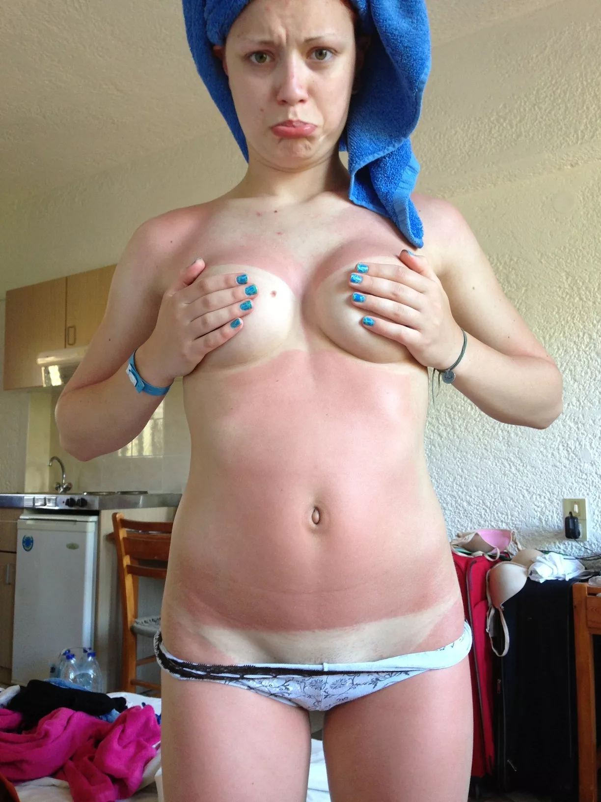 Sunburned Amateur posted by [deleted]