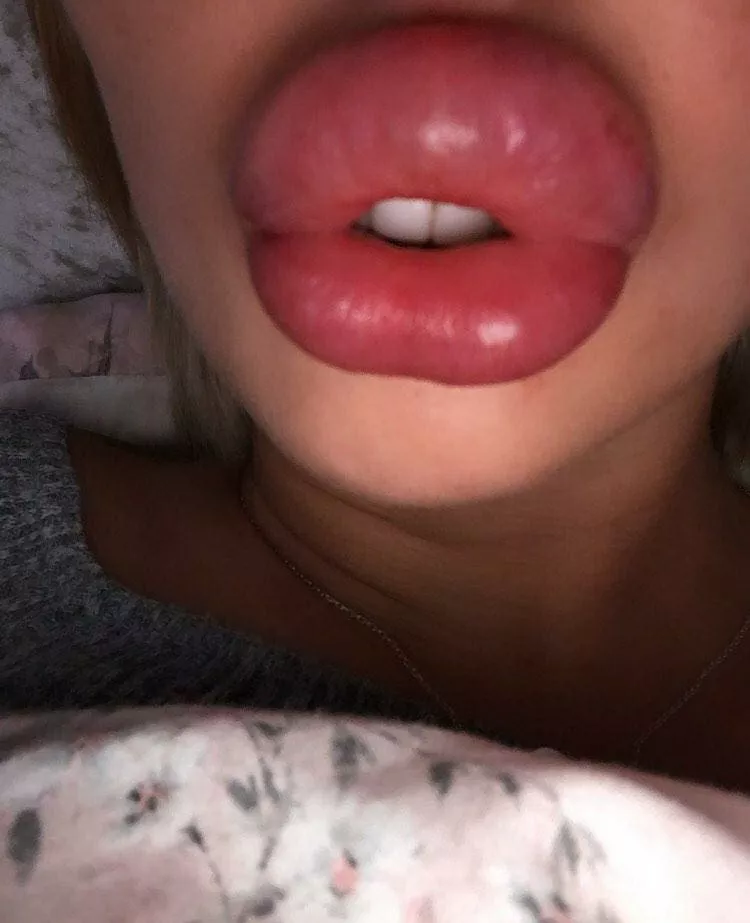 Super Swollen posted by gosterime