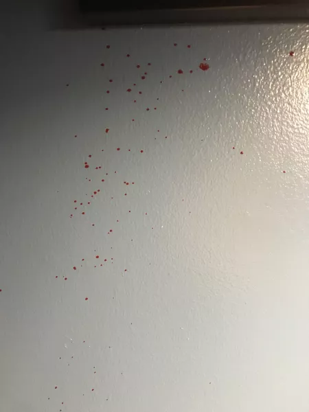 Surprise chest cyst, Part 2. I put my phone down to handle the second pop and this is what came out. by prosperacode