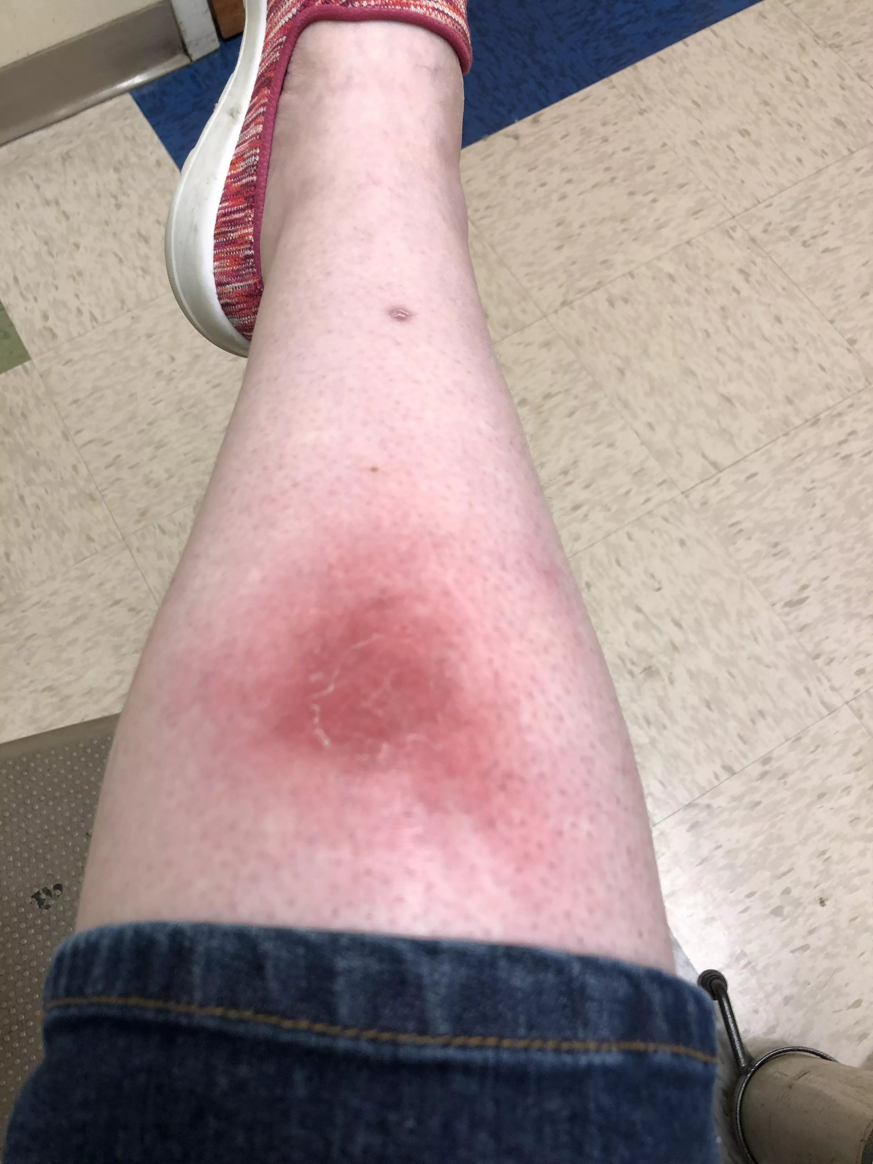 Thanks to you lovely people, I recognized cellulitis & got it treated before it got really bad! posted by psychkitty