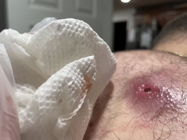 The aftermath of a cyst draining by chief1988