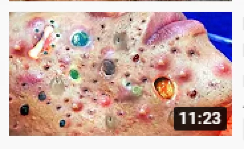 These thumbnails are getting out of control! Not gonna lie, I'd watch the heck out of colorful pimple pops! by psychnursegivesshots