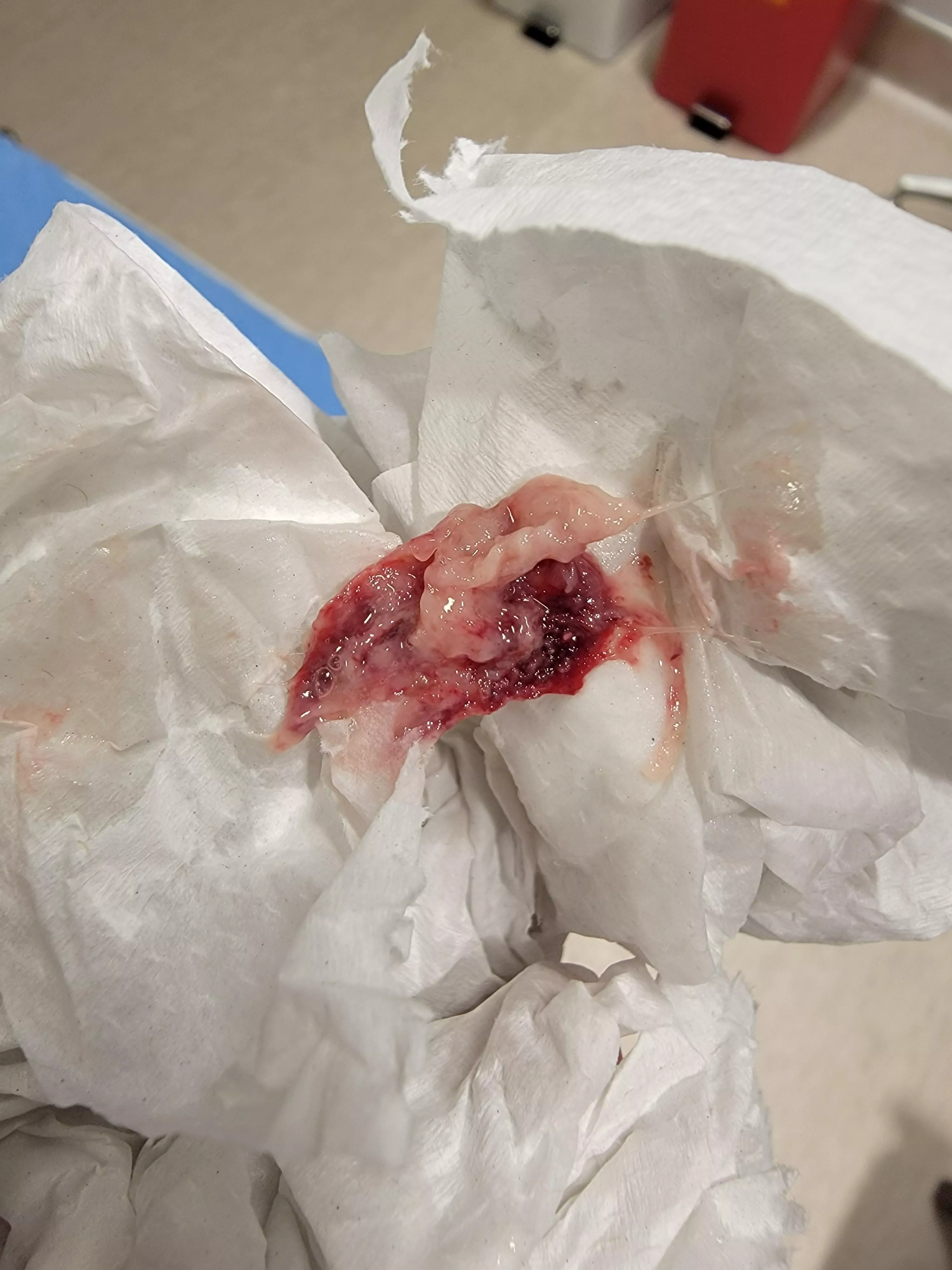 This came out of my nose. My eyeball and face felt great after it left 😌. Possible sinus infection. Posted here because Google lead me to this reddit posted by Leindo