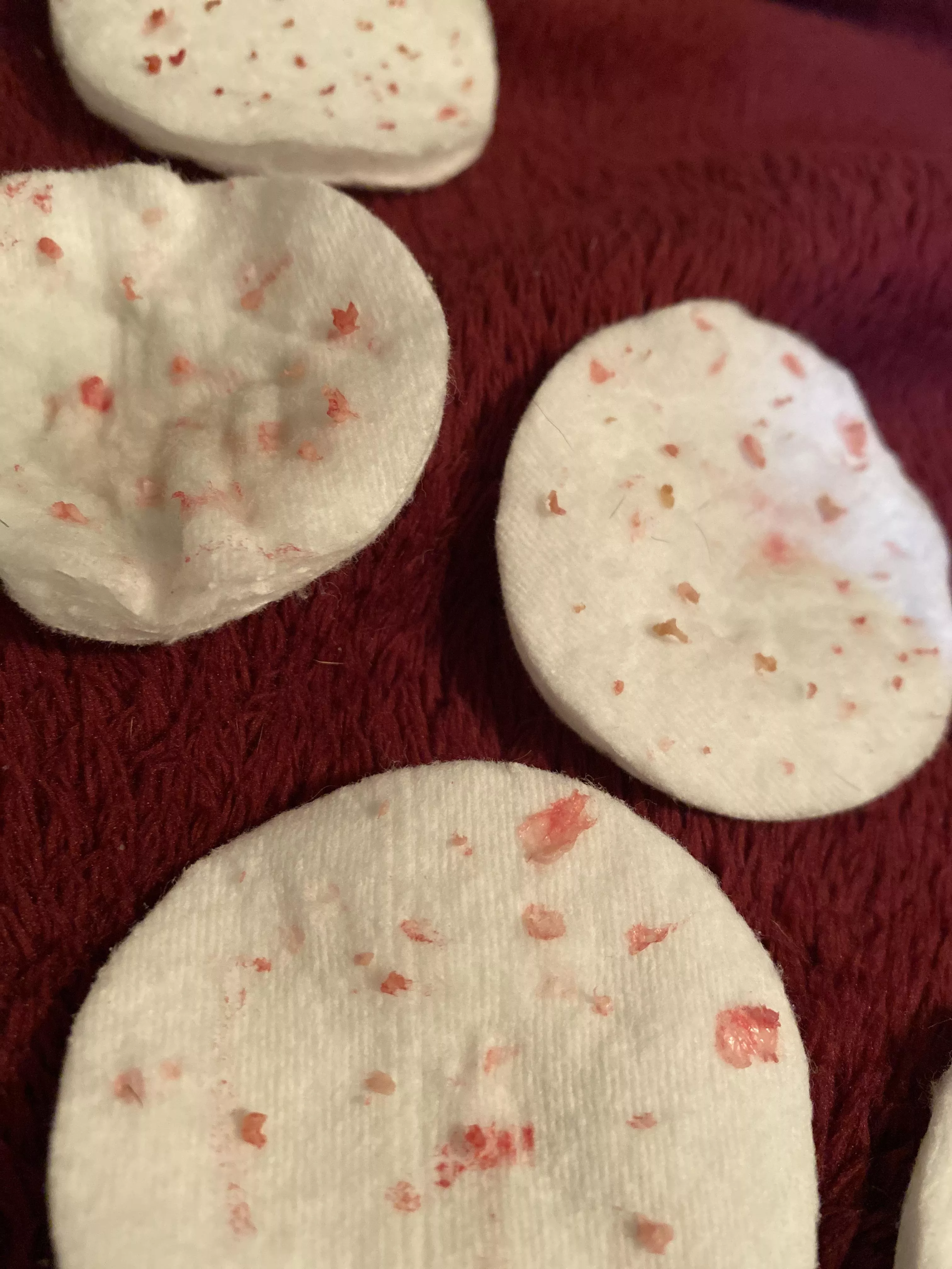 This is just a portion of all of the gunk I got out of my husband’s leg cyst. First time, no video, got the sac! posted by DaringDescriptivist