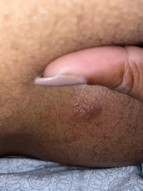 This is the 2nd time this popped up on my butt what is this. It itched but there was nothing there and like overnight it grew and has individual white heads by Scary_Set9980
