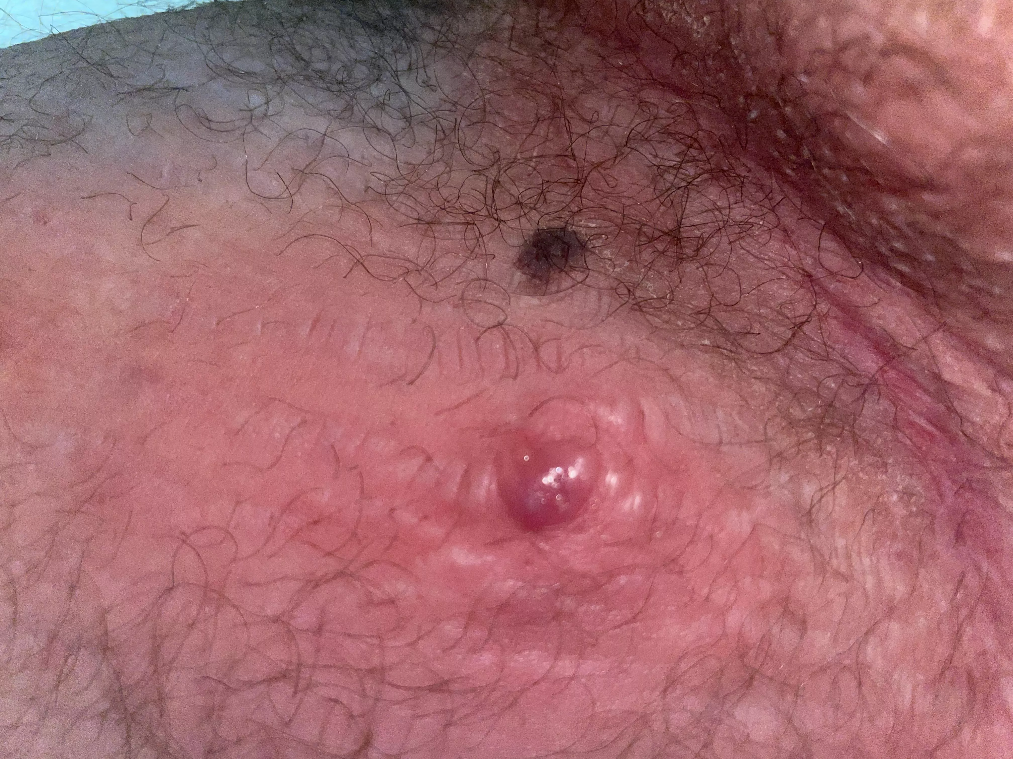 This little bastard popped up on my thigh yesterday, cyst I guess? posted by zach2791