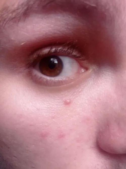 This little guy appeared on my face yesterday. Should I try to burst it with a needle? It seems like a little milia by Pedrao_zao